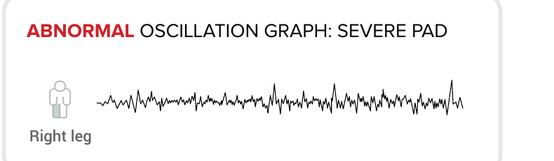 Abnormal oscillationsgraf vid svår PAD