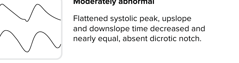 Pulsvågform: Måttligt avvikande