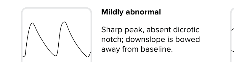 Pulsvågform: Milt avvikande