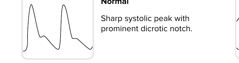 Pulsvågform: Normal