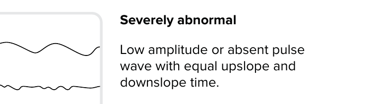 Pulsvågform: Svårt avvikande