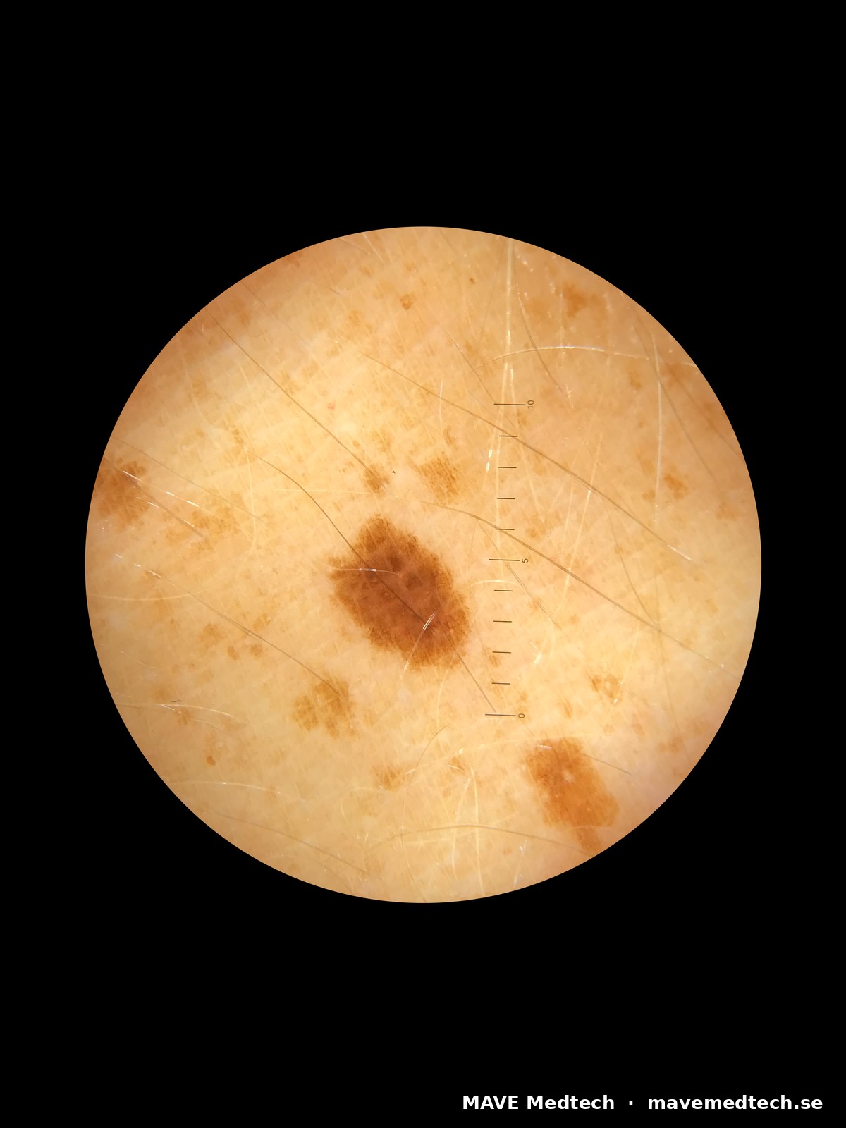 HEINE iC1 via HEINEderm-appen, polarisationsläge, iPhone 7