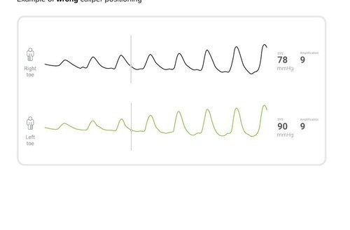Felaktig placering av mätlinjen